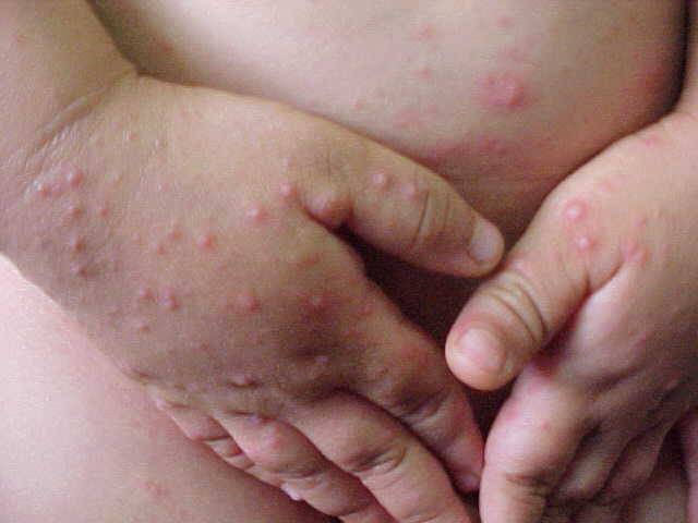 Los regímenes a la psoriasis por pegano