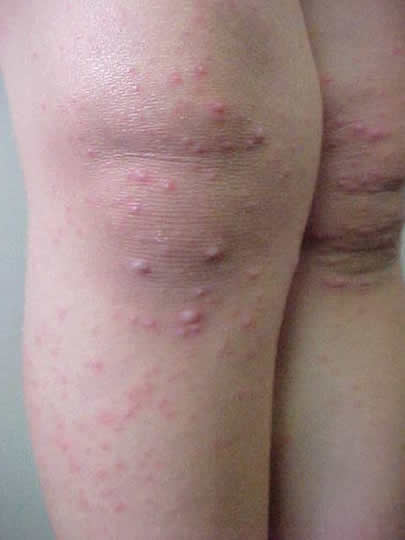 Los ungüentos de la psoriasis momat con los precios