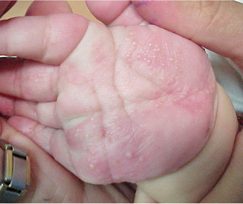 El bacteriófago a atopicheskom la dermatitis