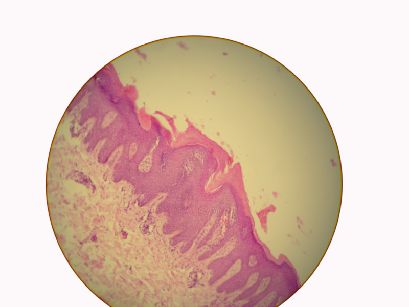 La psoriasis la probabilidad de la transmisión por herencia