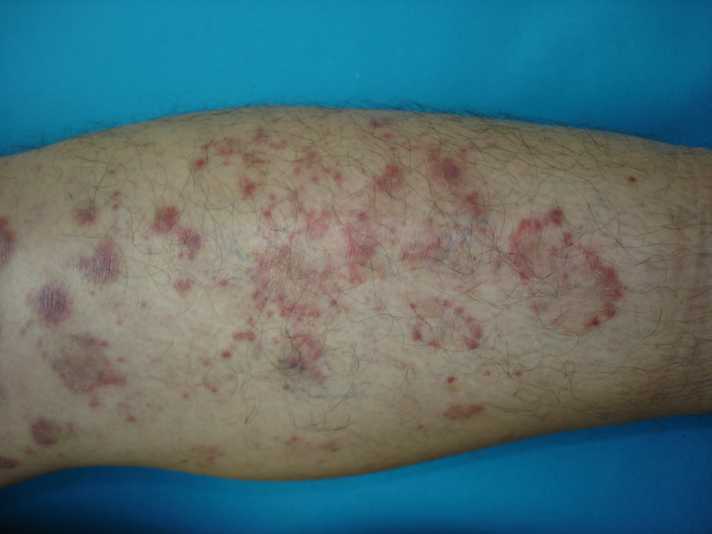 Las cocciones de las hierbas a atopicheskom la dermatitis