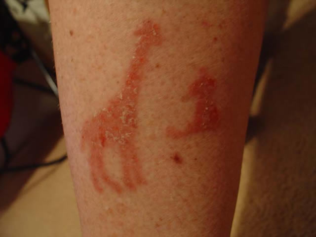 Atopichesky la dermatitis detrás de las orejas que curar